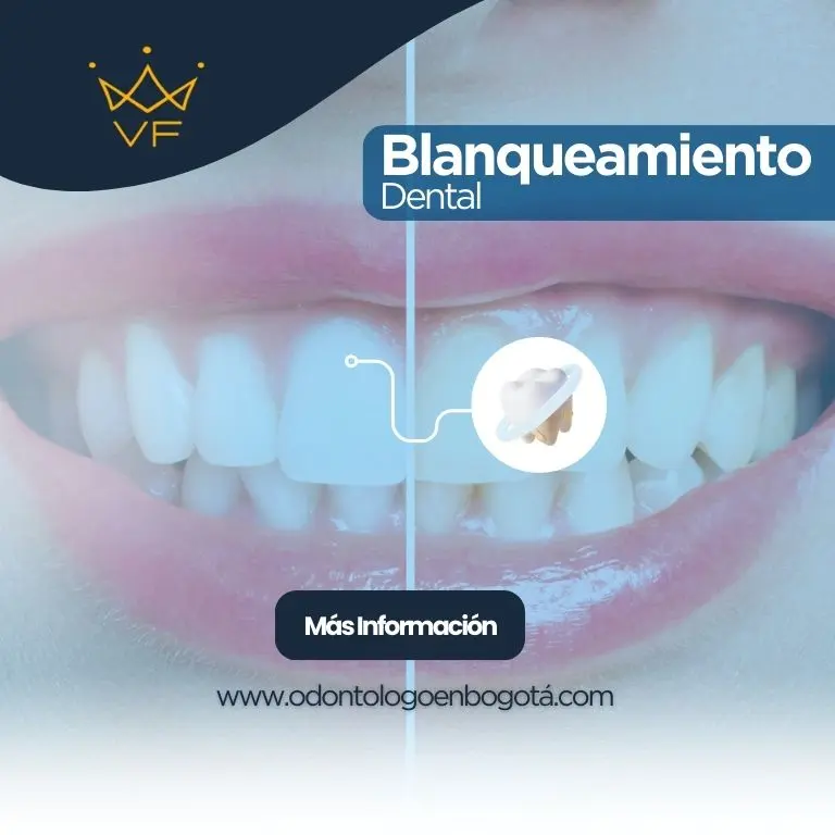 Blanqueamiento Dental