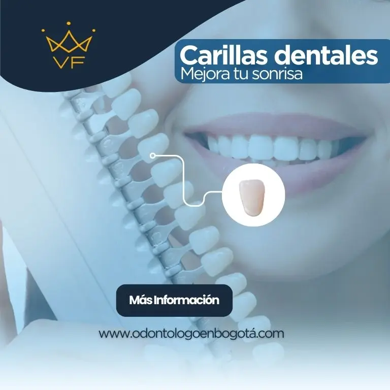 Carillas dentales