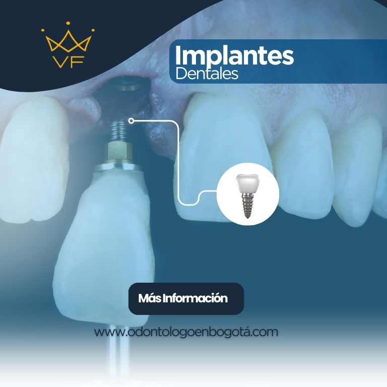 Implantes dentales