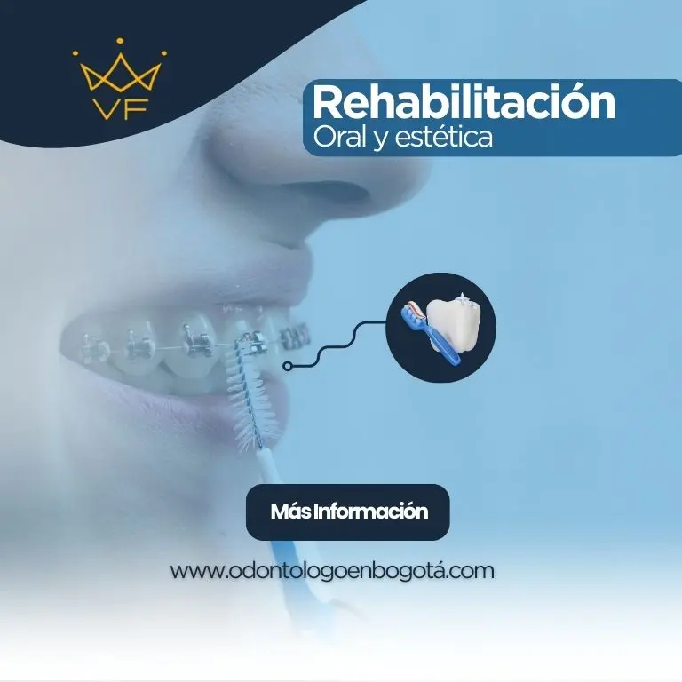 Rehabilitacion Oral y estetica