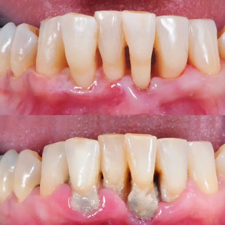 Limpieza Dental en Bogotá 16 Limpieza dental antes y ahora Dra. Veronica Forero